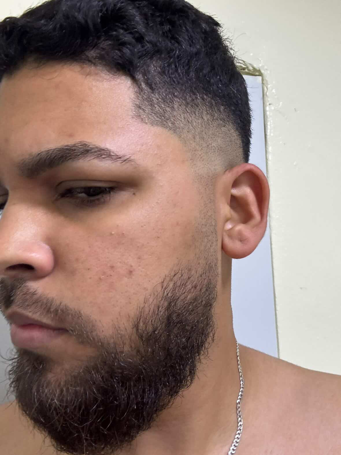 Antes: barba antes del proceso